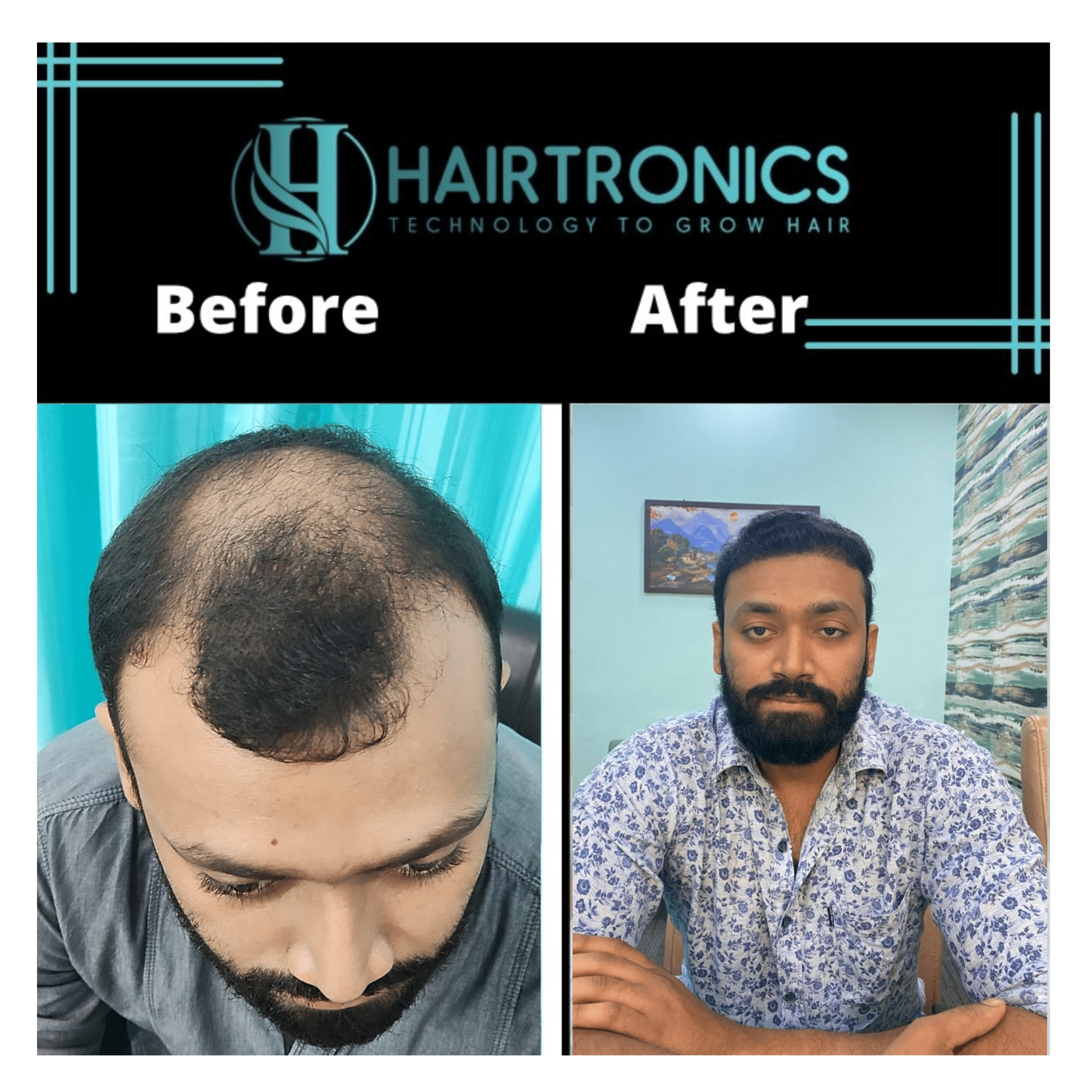 Beat hair Transplant