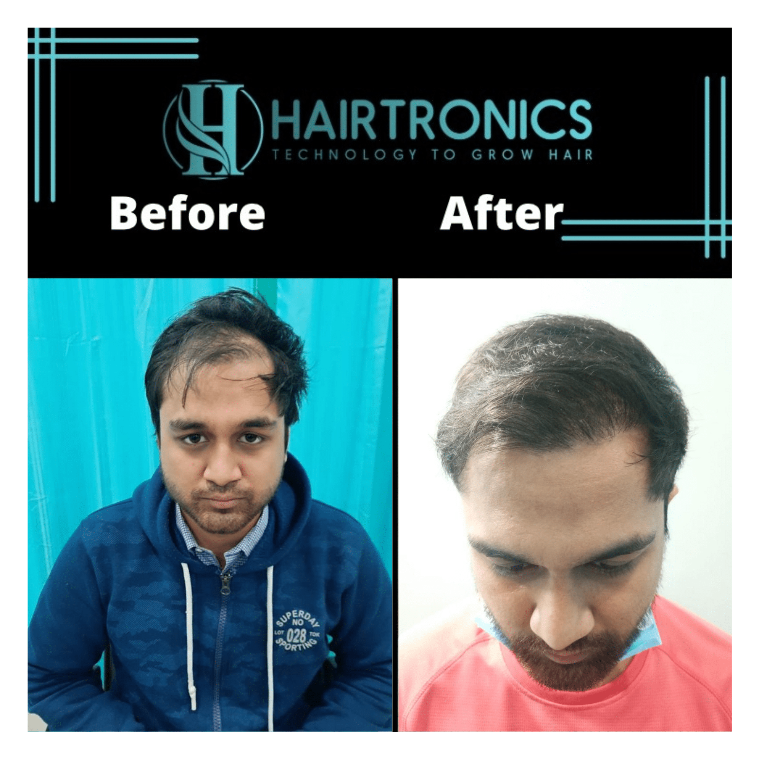 hair transplant result